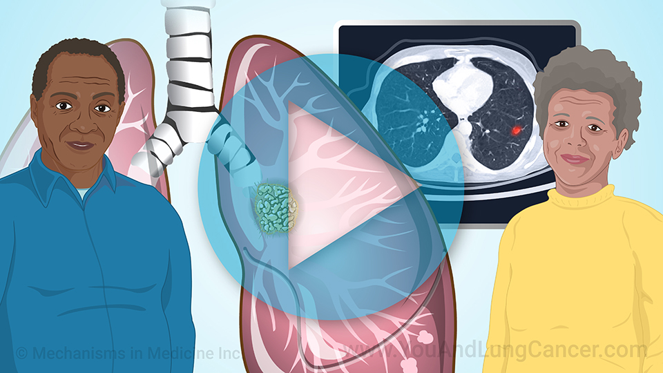 Animation - Early Detection and Screening for Lung Cancer in Black Americans