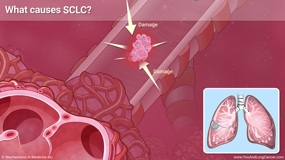 Slide Show - Understanding Small Cell Lung Cancer