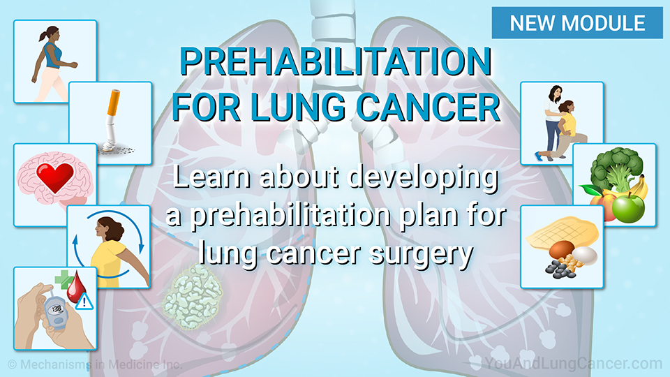 Understanding Prehabilitation in Lung Cancer Surgery.