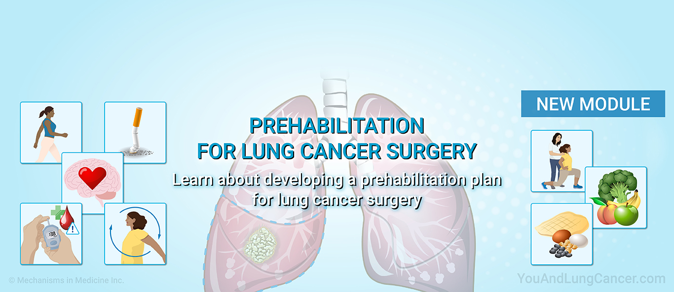 Understanding Prehabilitation for Lung Cancer Surgery.