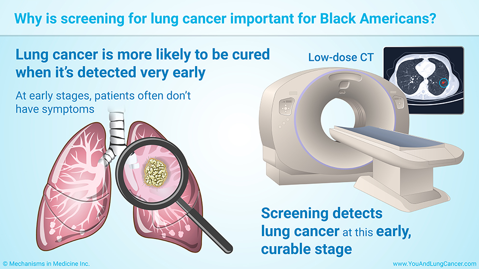 Slide Show - Early Detection and Screening for Lung Cancer in