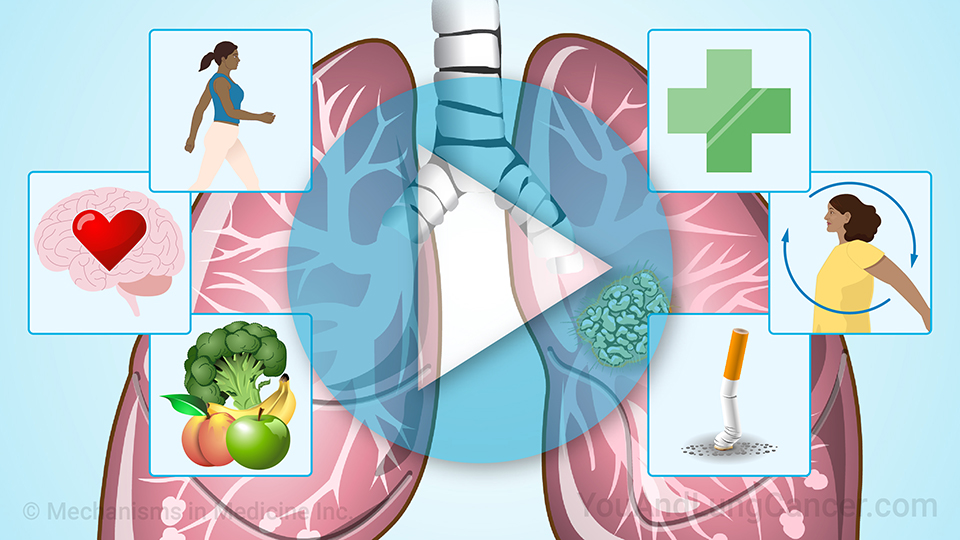 Understanding Prehabilitation for Lung Cancer Surgery