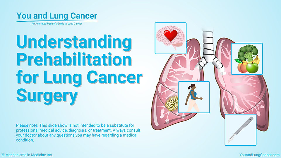 Slide Show - Understanding Prehabilitation for Lung Cancer Surgery