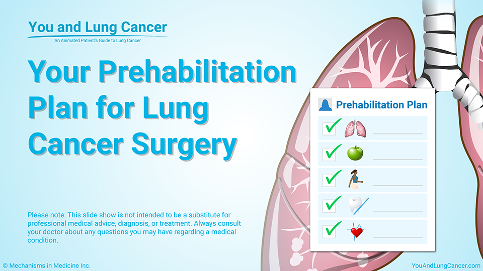 Slide Show - Your Prehabilitation Plan for Lung Cancer Surgery