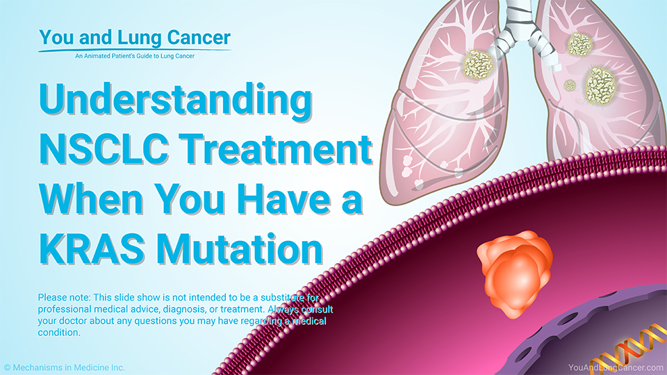 Understanding NSCLC Treatment When You Have a KRAS Mutation