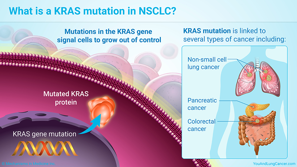 What is a KRAS mutation in non-small cell lung cancer (NSCLC)?