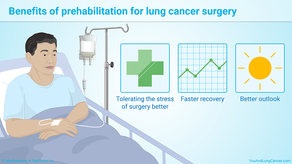 Benefits of prehabilitation for lung cancer surgery