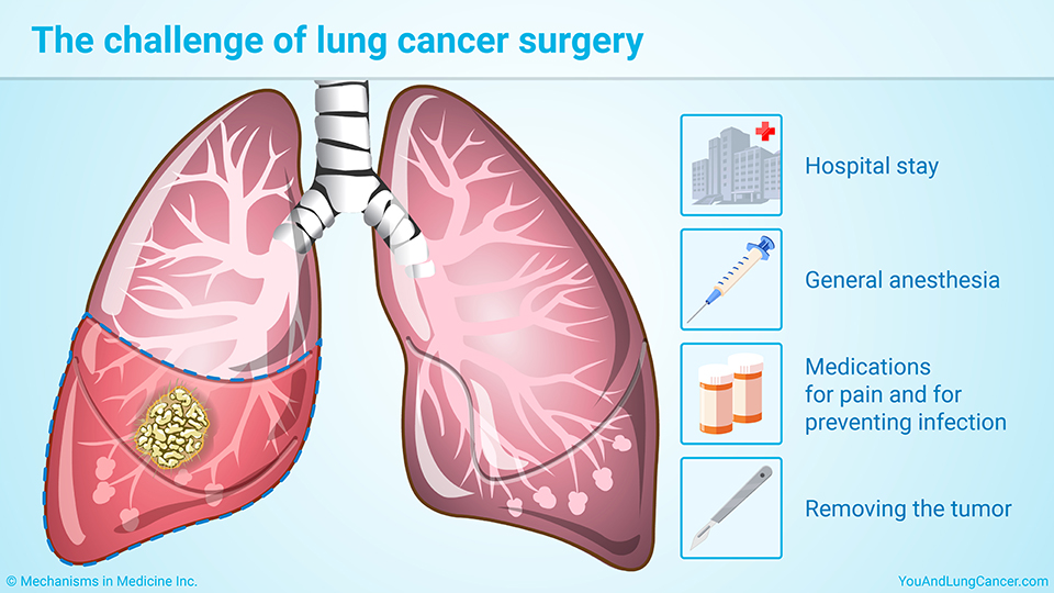 The challenge of lung cancer surgery