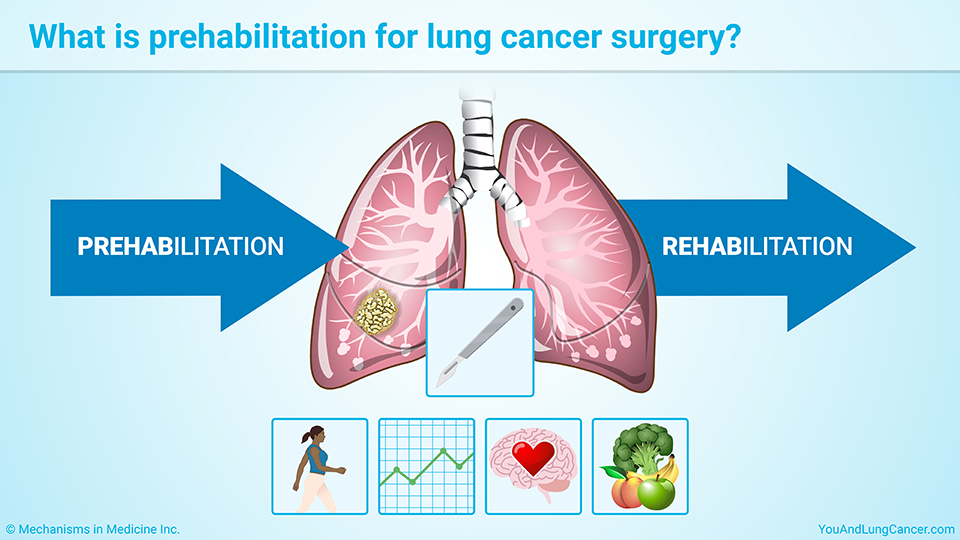 What is prehabilitation for lung cancer surgery?