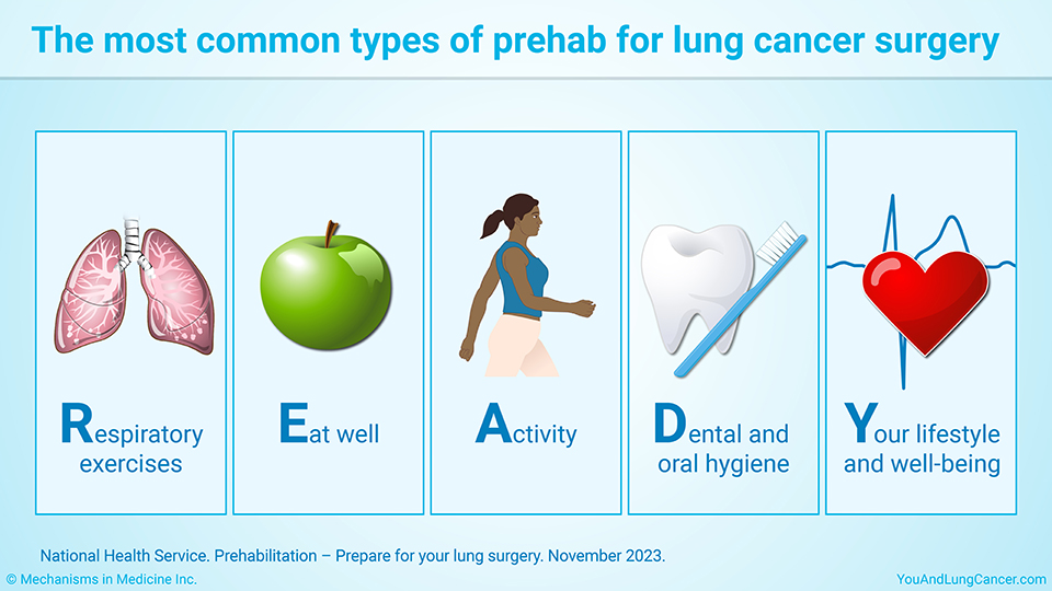 The most common types of prehab for lung cancer surgery