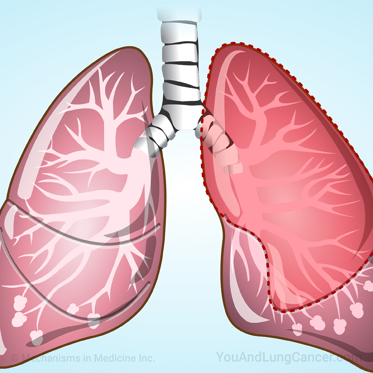 Understanding Surgery in Lung Cancer and Rehabilitation
